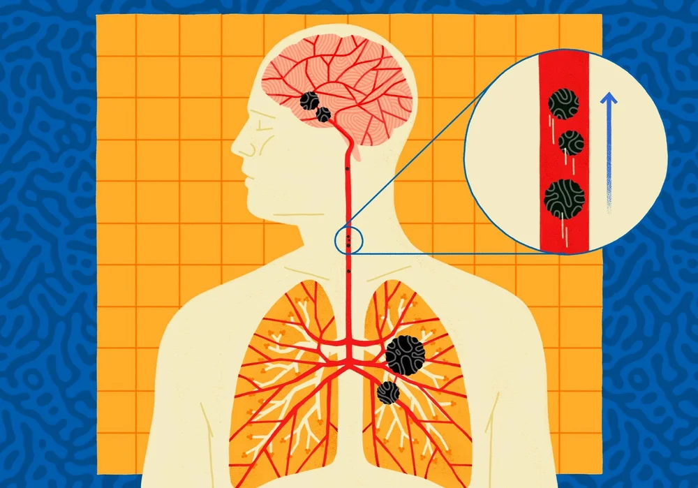 Montse Galbany - for Genentech - Understanding Brain Metastases